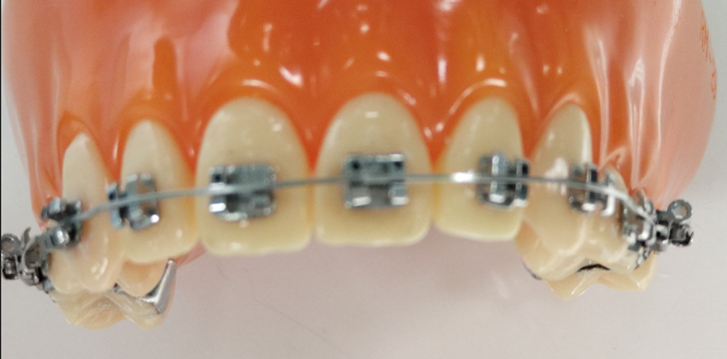 歯列矯正